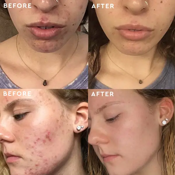 Private Label Neem Skincare Set